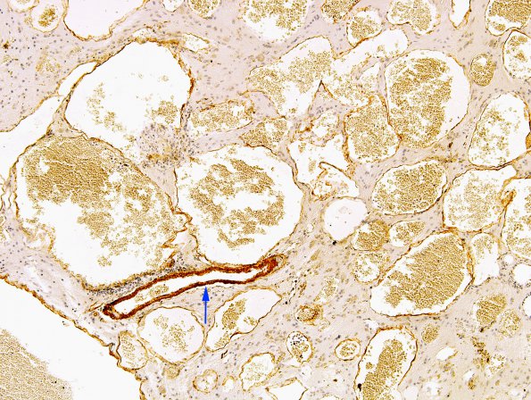 18E2 Cavernous Angioma (Case 18) SMA 2 copy