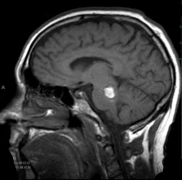 19A1 Cavernous Angioma (Case 19) T1 1 - Copy