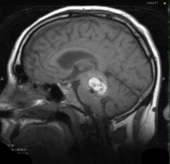 19A2 Cavernous Angioma (Case 19) (later) T1 1 - Copy