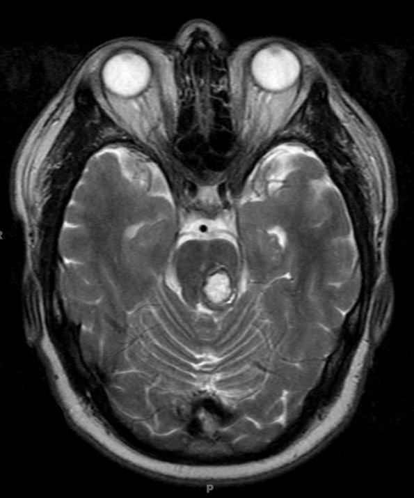 19A3 Cavernous Angioma (Case 19) T2 1 - Copy