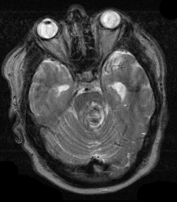 19A4 Cavernous Angioma (Case 19) (later) T2 W 1 - Copy