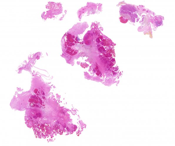 19B1 Cavernous Angioma (Case 19) H&E whole mount