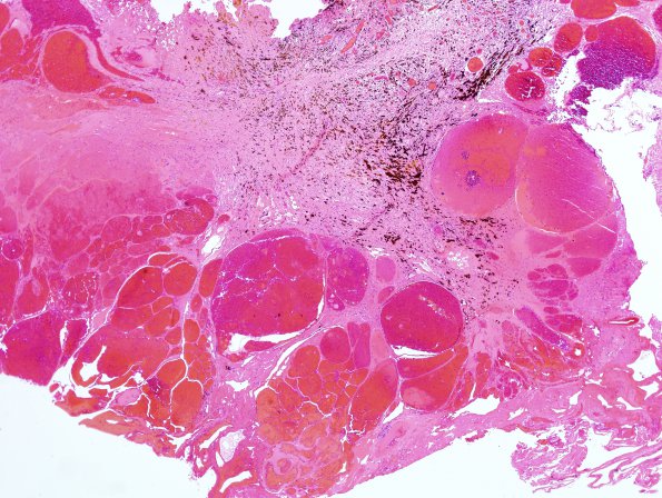 19B2 Cavernous Angioma (Case 19) H&E 3