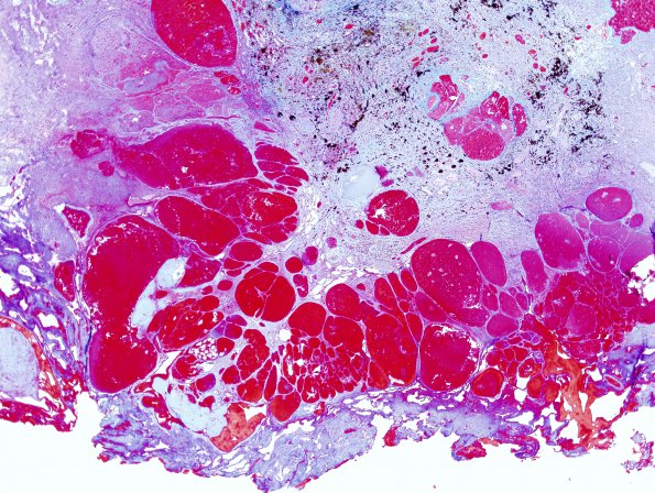 19C2 Cavernous Angioma (Case 19) Trichrome 3