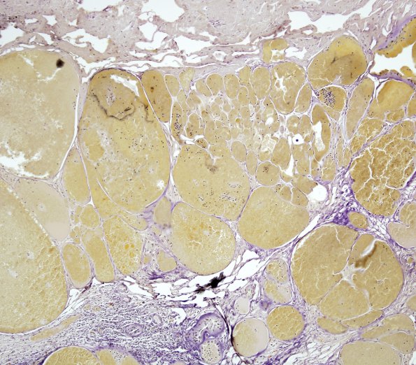 19D Cavernous Angioma (Case 19) VVG