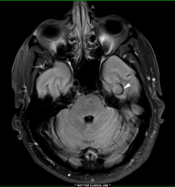 1A1 Cavernous Angioma (Case 1) FLAIR copy - Copy