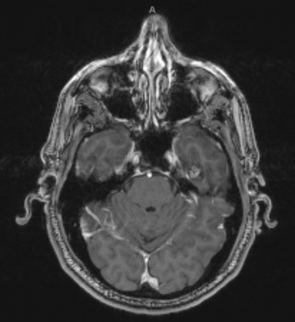 1A2 Cavernous Angioma (Case 1) T1 with contrast - Copy