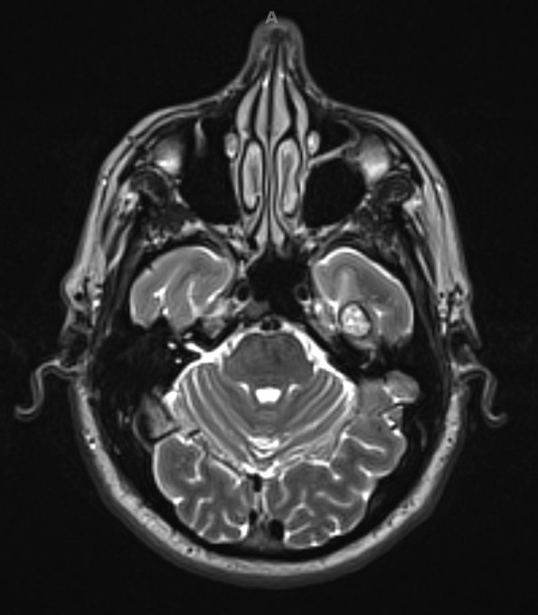 1A3 Cavernous Angioma (Case 1) T2 with contrast 2 - Copy