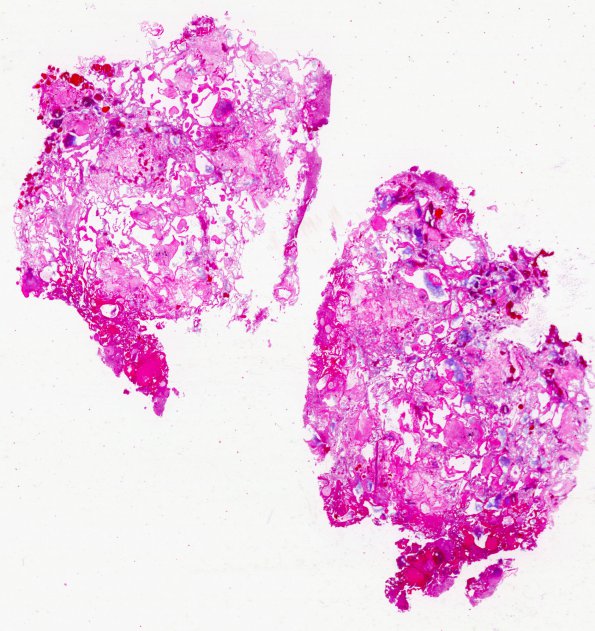 1B1 Cavernoma (Case 1) H&E WM