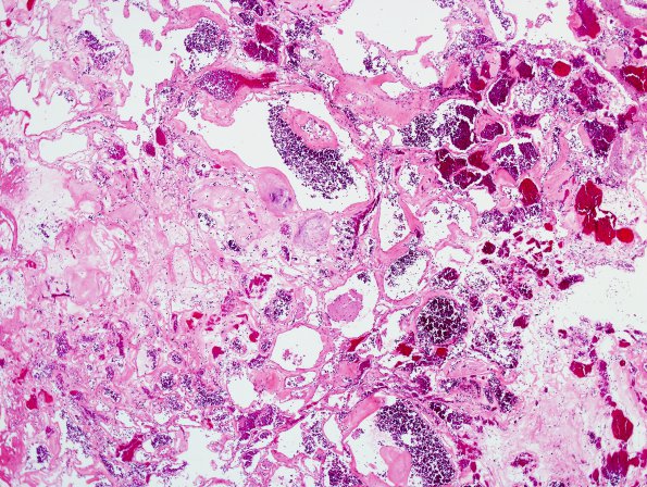 1B2 Cavernoma (Case 1) H&E 2