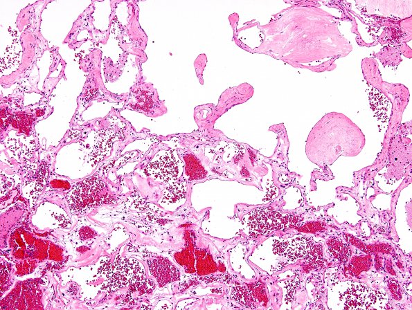 1B4 Cavernoma (Case 1) H&E 3