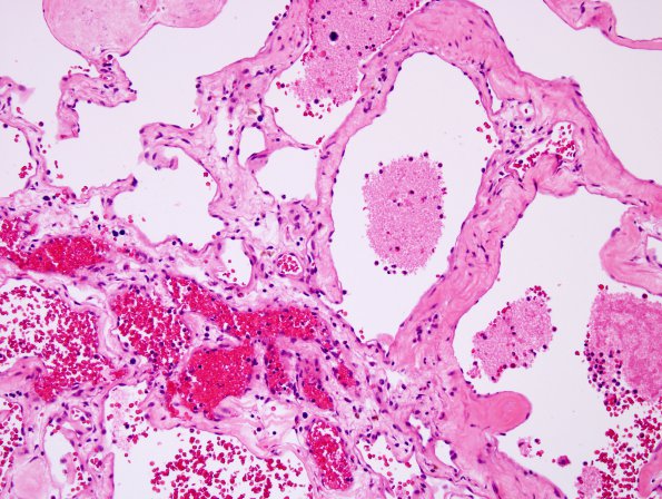 1B5 Cavernoma (Case 1) H&E 4