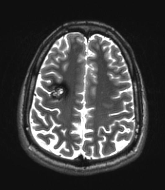 20A1 Cavernous angioma (Case 20) T2 W 1 - Copy