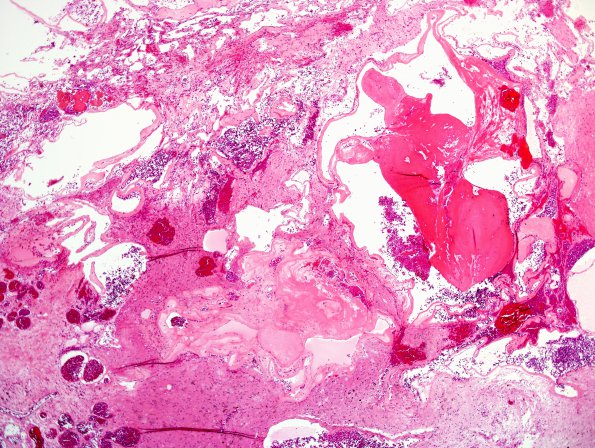 20B1 Cavernous angioma (Case 20) H&E 1