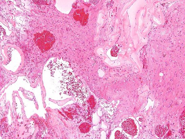 20B2 Cavernous angioma (Case 20) H&E 2