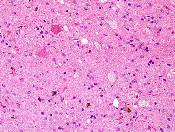 20B3 Cavernous angioma (Case 20) H&E 3