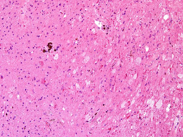 20B4 Cavernous angioma (Case 20) H&E 7