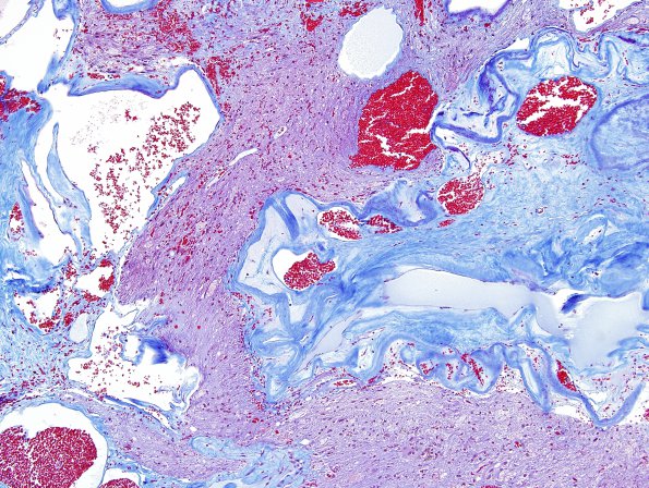 20C1 Cavernous angioma (Case 20) Trichrome 2