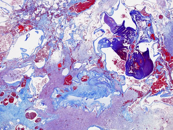 20C2 Cavernous angioma (Case 20) Trichrome 3