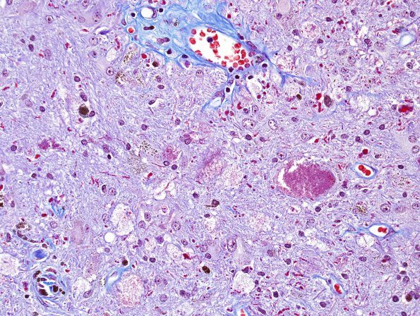 20C3 Cavernous angioma (Case 20) Trichrome 4