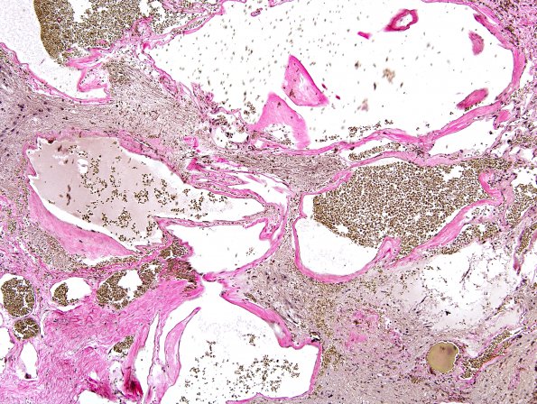 20D Cavernous angioma (Case 20) Elastin 6