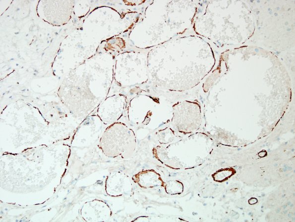 20E Cavernous angioma (Case 20) SMA 2