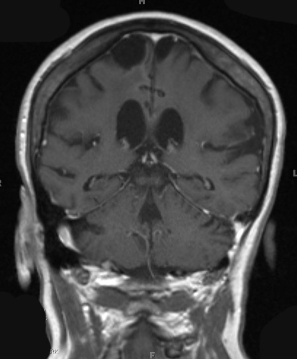 21A1  Hypoxia-Ischemia, venous anomaly, cavernoma (Case 21) T1 W 5 - Copy - Copy