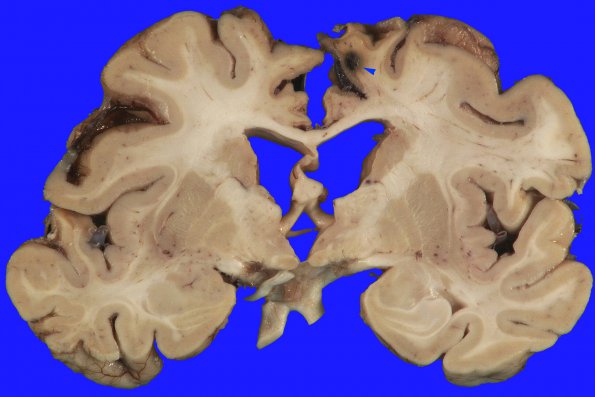 21B Hypoxia-Ischemia, venous anomaly, cavernoma (Case 21) 7 copy