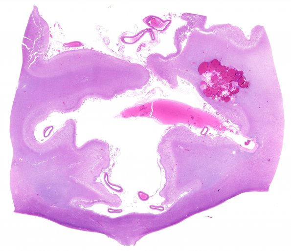 21C1 Hypoxia-Ischemia, venous anomaly, cavernoma (Case 21) H&E 19