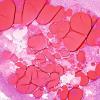 21C2 Hypoxia-Ischemia, venous anomaly, cavernoma (Case 21) H&E 1.