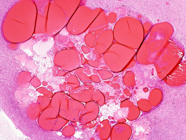 21C2 Hypoxia-Ischemia, venous anomaly, cavernoma (Case 21) H&E 1.