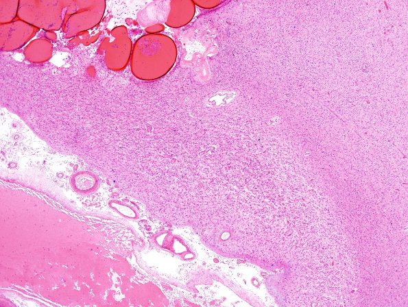 21C3 Hypoxia-Ischemia, venous anomaly, cavernoma (Case 21) H&E 5