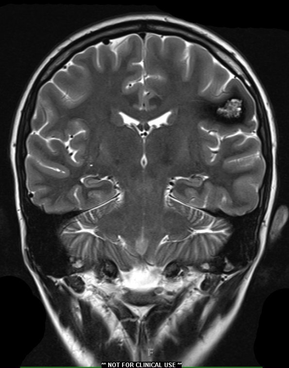 22A1 Cavernous angioma (Case 22) T2 1 - Copy