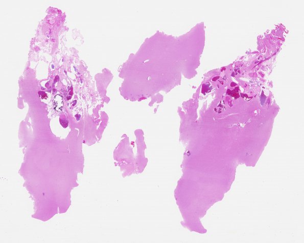 22B1 Cavernous angioma (Case 22) H&E WM