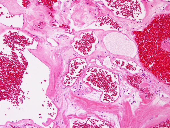 22B2 Cavernous angioma (Case 22) H&E 3