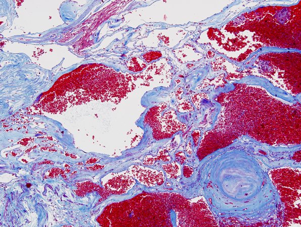 22C2 Cavernous angioma (Case 22) Trichrome 3