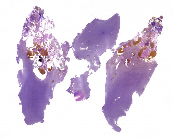 22D1 Cavernous angioma (Case 22) VVG