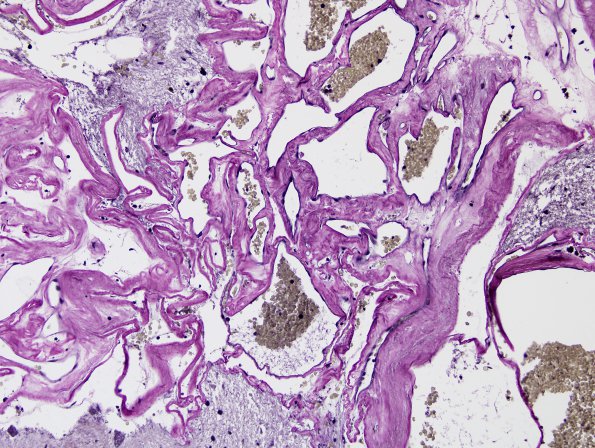 22D2 Cavernous angioma (Case 22) VVG 1