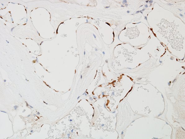 22E2 Cavernous angioma (Case 22) SMA 