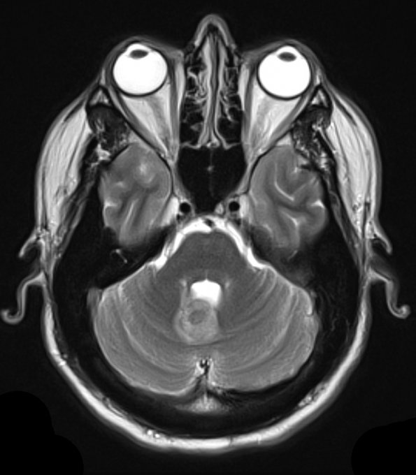 23A1 Cavernous angioma (Case 23) T2 1 - Copy