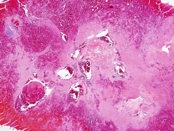 23B Cavernous angioma (Case 23) H&E 2