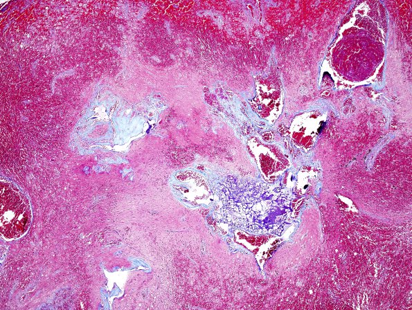 23C1 Cavernous angioma (Case 23) Trichrome 2