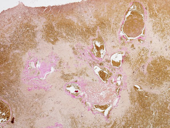 23D1 Cavernous angioma (Case 23) Elastin 2