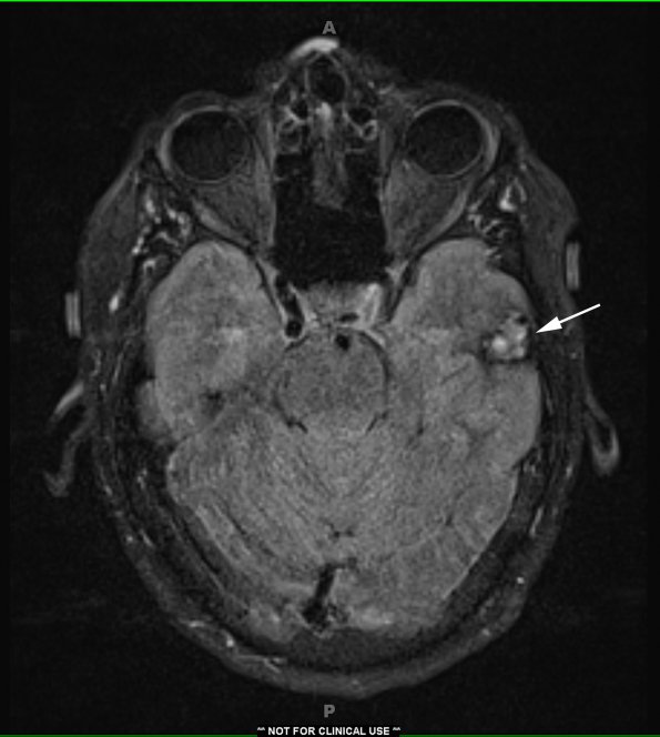 24A1 Cavernoma (Case 24) FLAIR copy - Copy