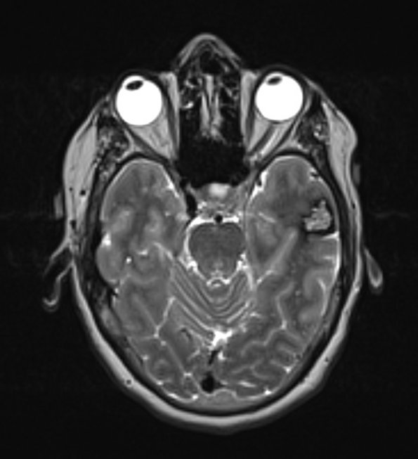 24A4 Cavernoma (Case 24) T2 with contrast - Copy