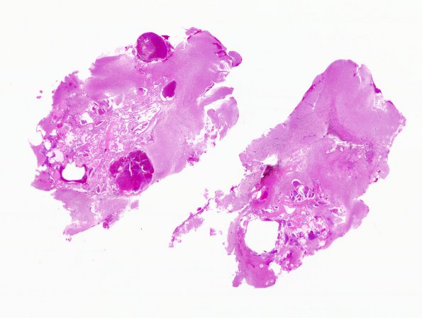 24B1 Cavernous Angioma (Case 24) Whole Mount