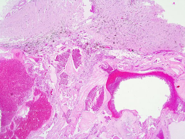 24B2 Cavernous Angioma (Case 24) 1