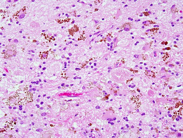 24B3 Cavernous Angioma (Case 24) 4