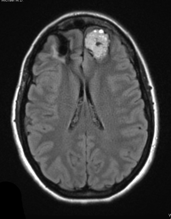 25A1 Cavernous Angioma (Case 25) FLAIR 2 - Copy