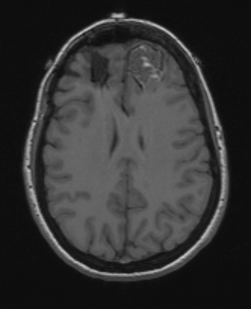 25A2 Cavernous Angioma (Case 25) T1 1 - Copy